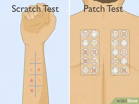 Imagen titulada Patch Test Skin Step 1