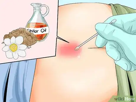 Imagen titulada Treat a Pilonidal Cyst Step 9