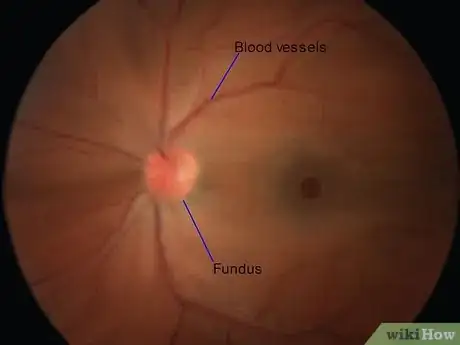 Imagen titulada Use an Ophthalmoscope Step 14