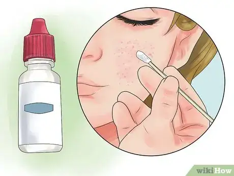 Imagen titulada Have an Acne Free Face Step 50
