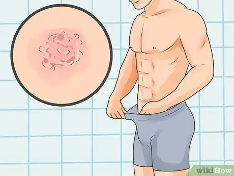 Imagen titulada Test for Herpes Step 1