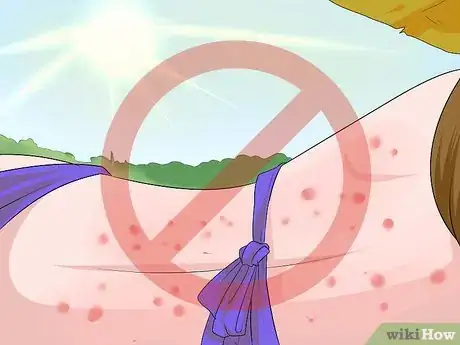 Imagen titulada Get Rid of Back Acne Fast Step 13