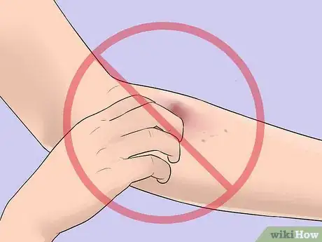 Imagen titulada Know when Your Vein Has Collapsed Step 3