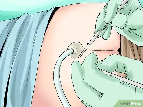 Imagen titulada Treat a Pilonidal Cyst Step 2