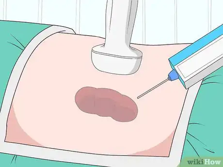 Imagen titulada Reduce Protein in Urine Step 9