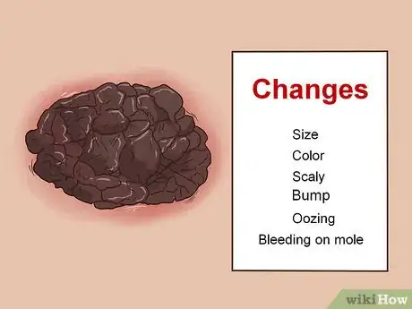 Imagen titulada Recognize Melanoma Step 16