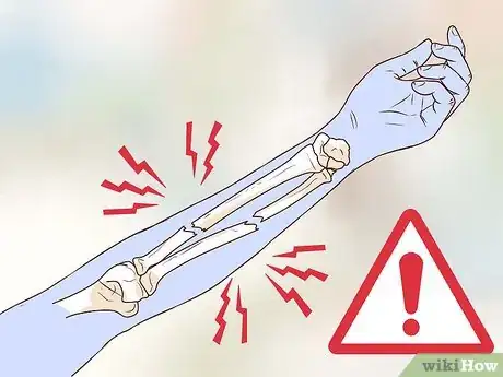 Imagen titulada Treat an Open Fracture During First Aid Step 13