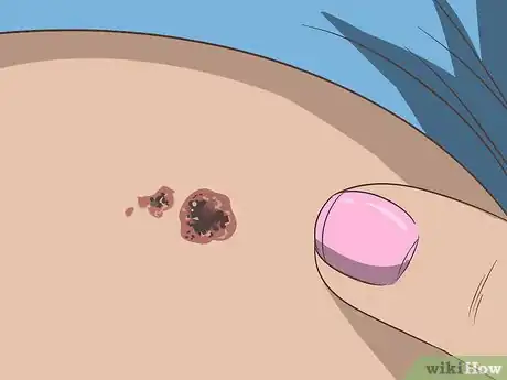 Imagen titulada Recognize Melanoma Step 10