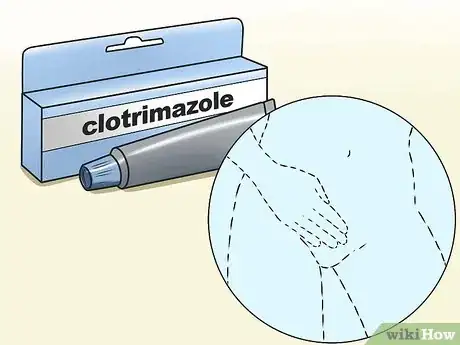 Imagen titulada Stop Vaginal Itching Step 6