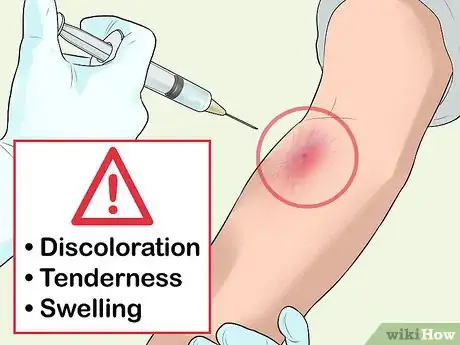 Imagen titulada Know when Your Vein Has Collapsed Step 1