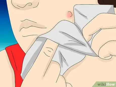 Imagen titulada Painlessly Pop a Pimple Step 7