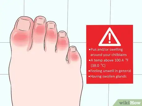 Imagen titulada Get Rid of Chilblains Step 7