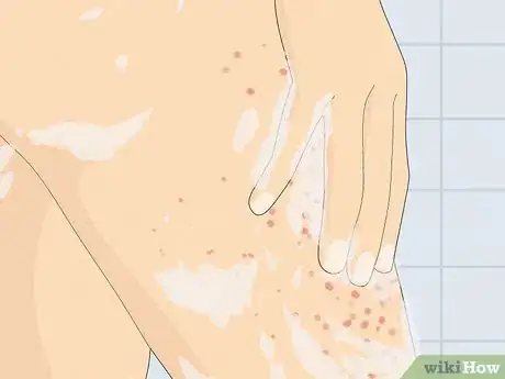 Imagen titulada Treat a Face Rash After Waxing Step 10