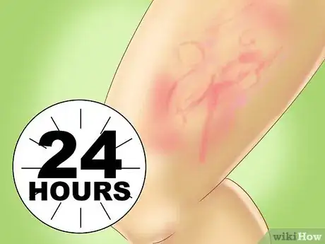 Imagen titulada Recognize Hives (Urticaria) Step 4