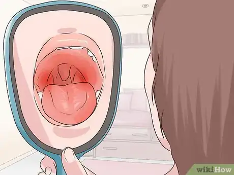 Imagen titulada Reduce Uvula Swelling Step 11