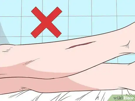Imagen titulada Apply a Skin Traction Step 2