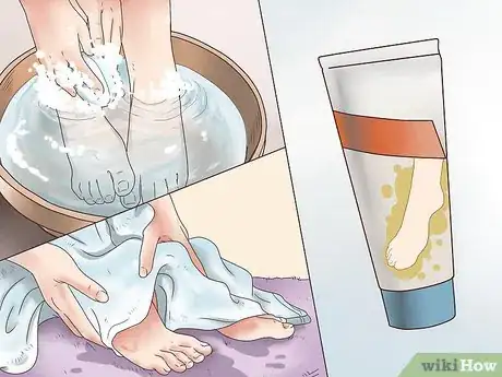 Imagen titulada Get Rid of Corns Step 7