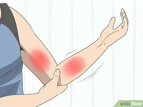 Imagen titulada Heal a Pulled Trapezius Muscle Step 2