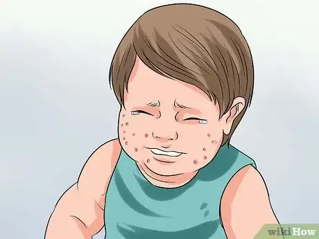 Imagen titulada Diagnose Scabies Step 5
