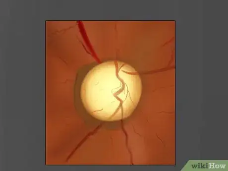 Imagen titulada Use an Ophthalmoscope Step 13