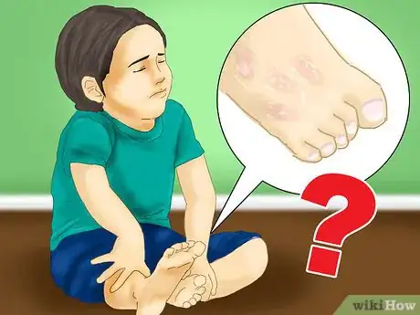 Imagen titulada Recognize Hives (Urticaria) Step 7