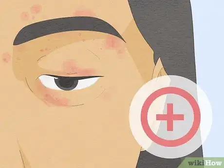 Imagen titulada Treat a Face Rash After Waxing Step 8