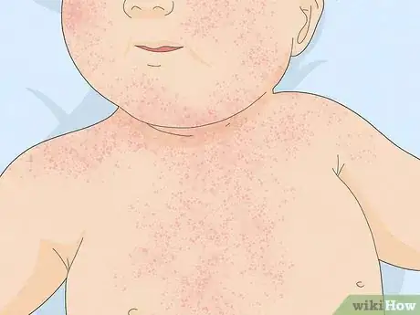 Imagen titulada Treat Baby Heat Rash Step 7