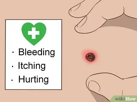 Imagen titulada Recognize Melanoma Step 11