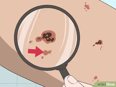 Imagen titulada Recognize Melanoma Step 13