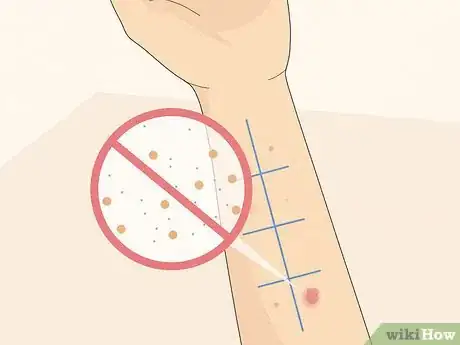 Imagen titulada Patch Test Skin Step 9