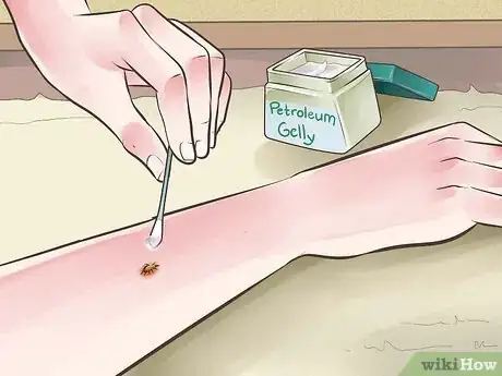 Imagen titulada Heal from a Skin Biopsy Step 7