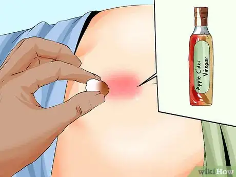 Imagen titulada Treat a Pilonidal Cyst Step 7