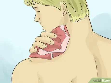 Imagen titulada Remove a Hickey Step 2