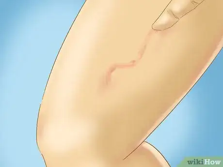 Imagen titulada Recognize Hives (Urticaria) Step 5