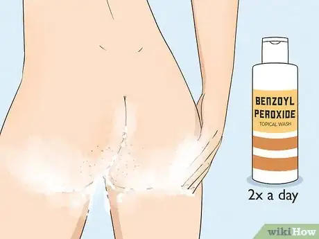 Imagen titulada Get Rid of Acne on the Buttocks Step 8