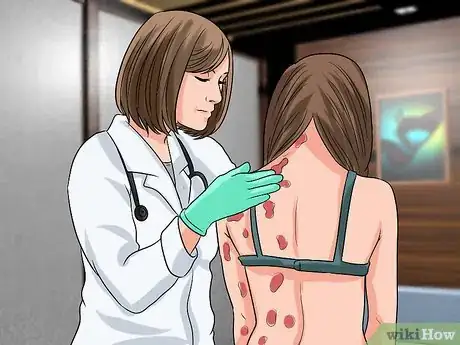 Imagen titulada Diagnose Scabies Step 8