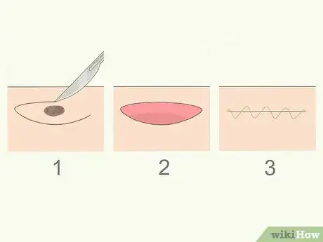 Imagen titulada Remove Moles Quickly Step 4