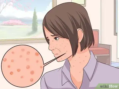 Imagen titulada Recognize Chickenpox Step 20