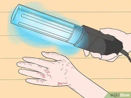 Imagen titulada Treat Hand Eczema Step 13