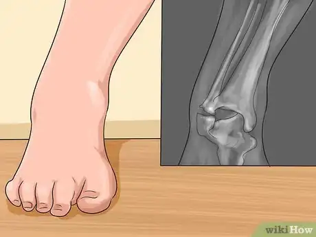 Imagen titulada Know if You've Sprained Your Ankle Step 9