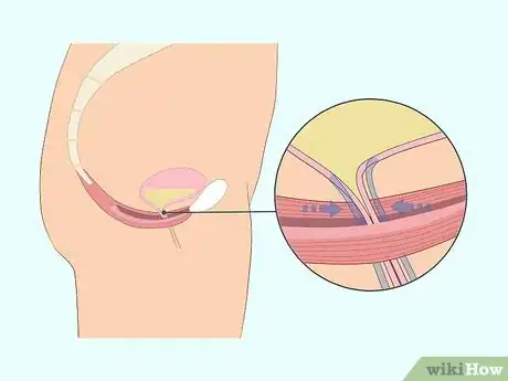 Imagen titulada Do Kegel Exercises Step 1