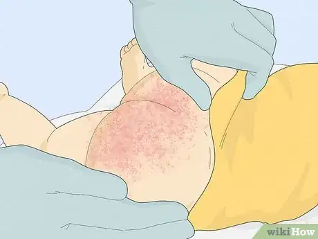 Imagen titulada Treat Baby Heat Rash Step 10