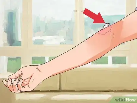 Imagen titulada Treat an Open Fracture During First Aid Step 3