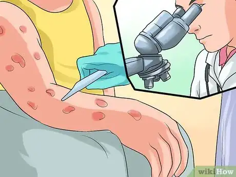 Imagen titulada Diagnose Scabies Step 9
