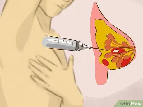 Imagen titulada Treat Breast Cysts Step 10