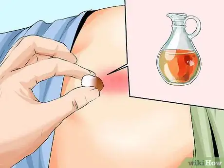Imagen titulada Treat a Pilonidal Cyst Step 6
