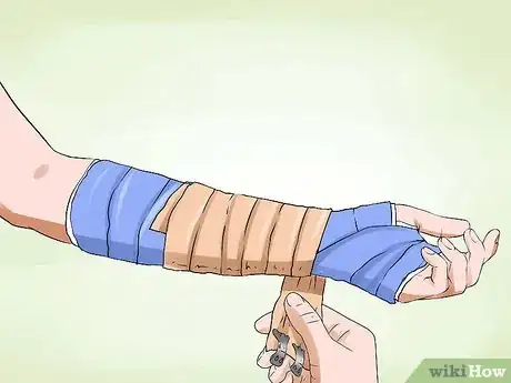Imagen titulada Manage a Broken Arm Step 11
