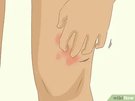 Imagen titulada Know If You Have Worms Step 17