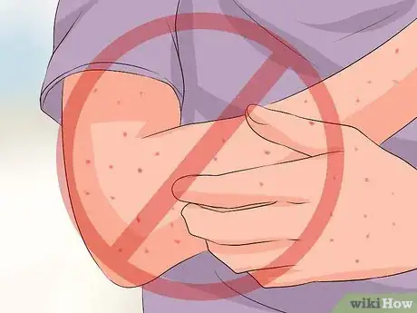 Imagen titulada Recognize Chickenpox Step 11