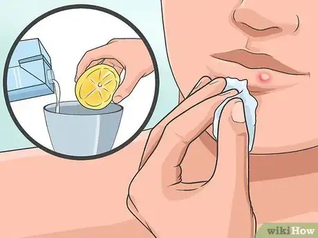 Imagen titulada Heal a Cold Sore Naturally Step 8